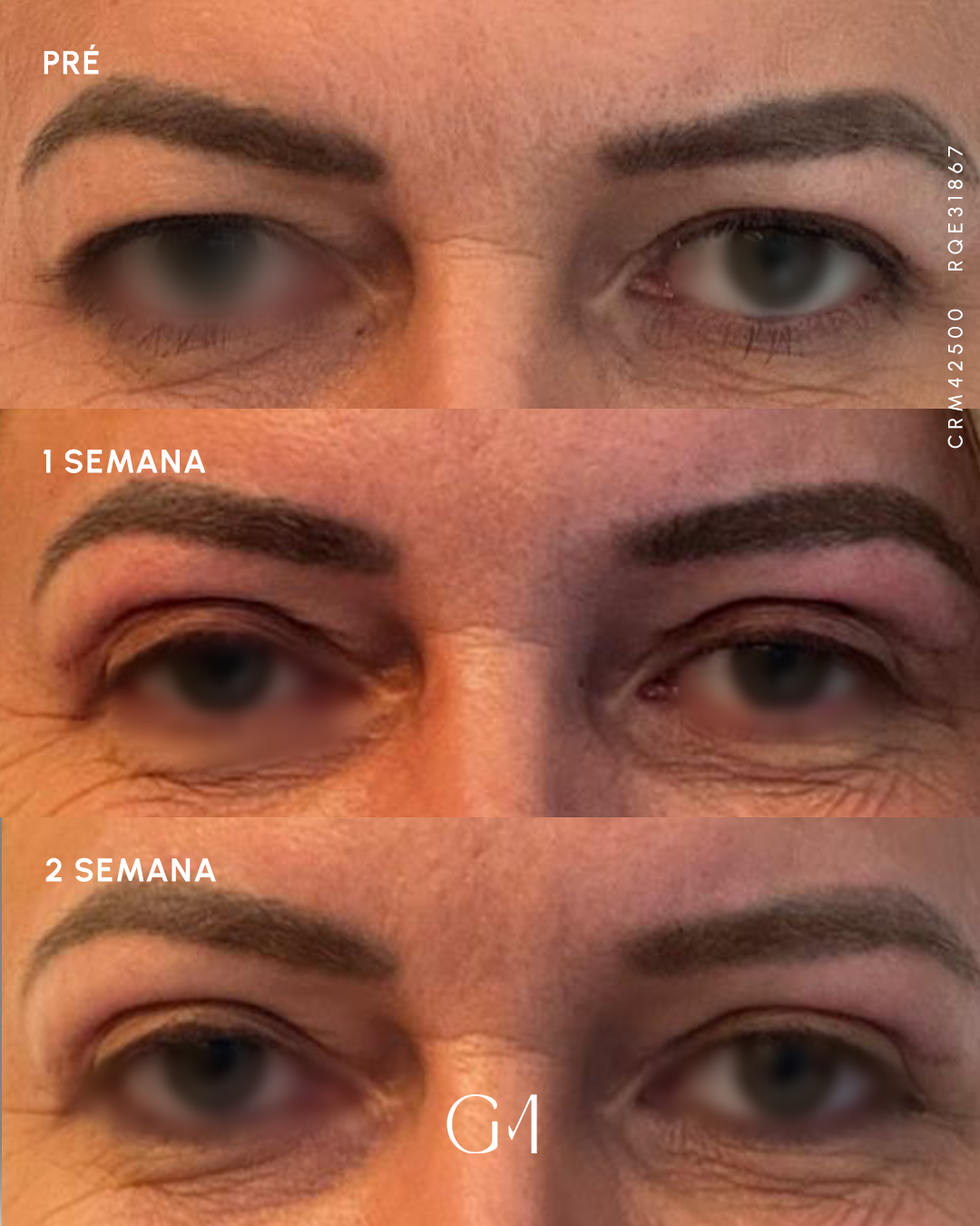 Antes e depois de blefaroplastia - Dra. Gabriela Moraes