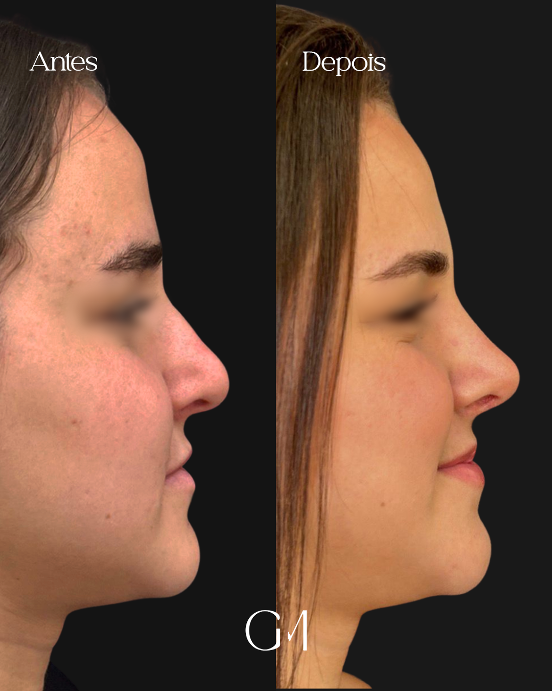 Antes e depois de rinoplastia - Dra. Gabriela Moraes